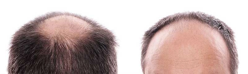 5 New Hair Loss Cure Options