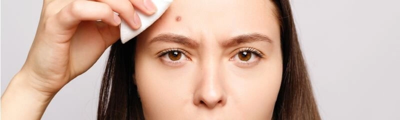 How Acne Medication Limits Skin Breakouts 