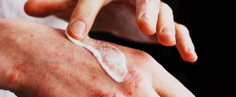 Understanding Dry Skin and Atopic Dermatitis 