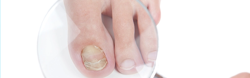 effective treatment for toenail fungus