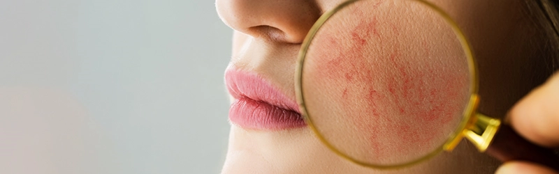 how to get rid of redness on face