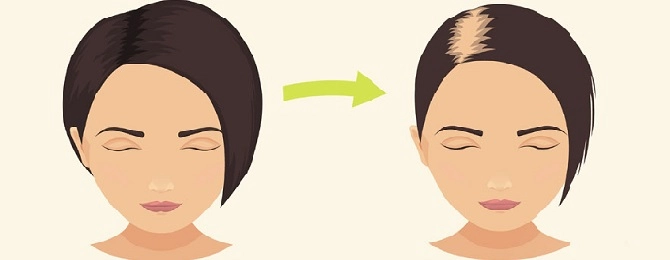 Hair Today, Gone Tomorrow: The Real Deal on Hair Loss