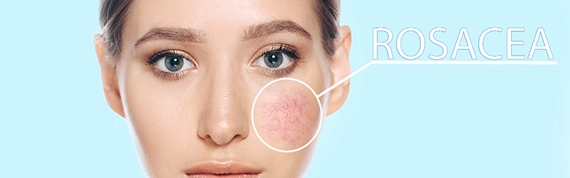 How Do You Clear Up Rosacea?