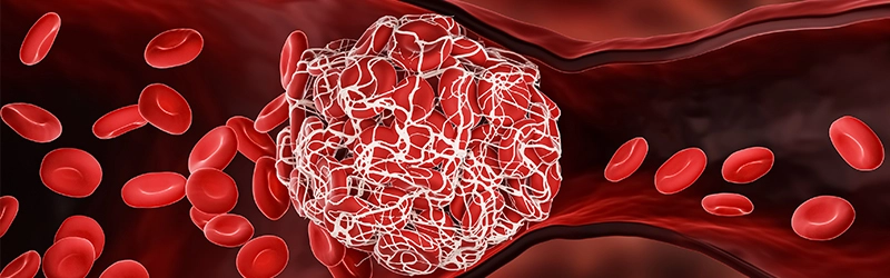 types of blood clots