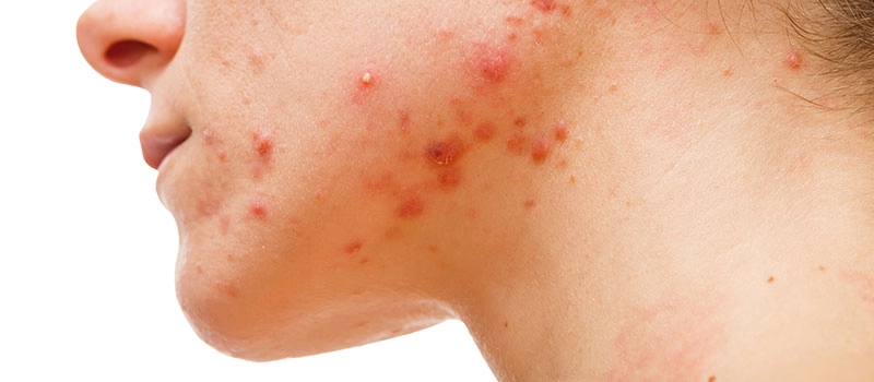 What Causes Acne in Adolescents and Adults? Dispel the Myths