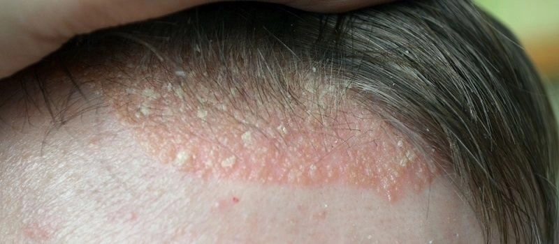 what causes scalp psoriasis